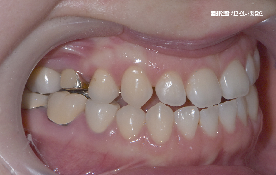 반대교합 치아교정 해결 가능할까 관련 이미지 2