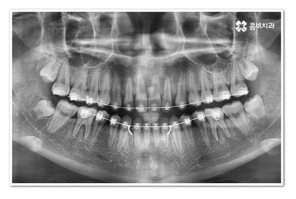 앞니 벌어짐 똑똑하게 해결하려면 관련 이미지 8