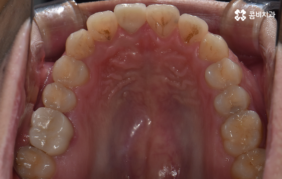 아랫니교정 이렇게만 파악하시면 됩니다 관련 이미지 4