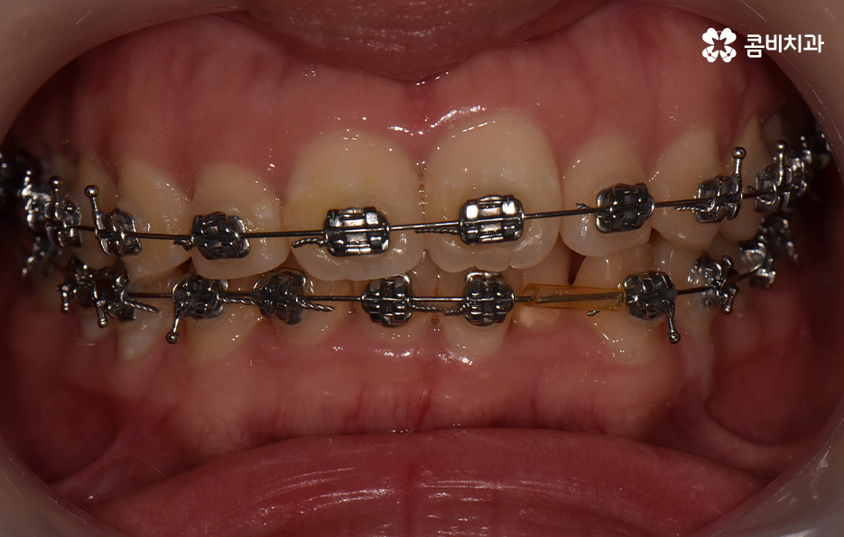 앞니 틀어짐 교정으로 해결하면 될까요 관련 이미지 7