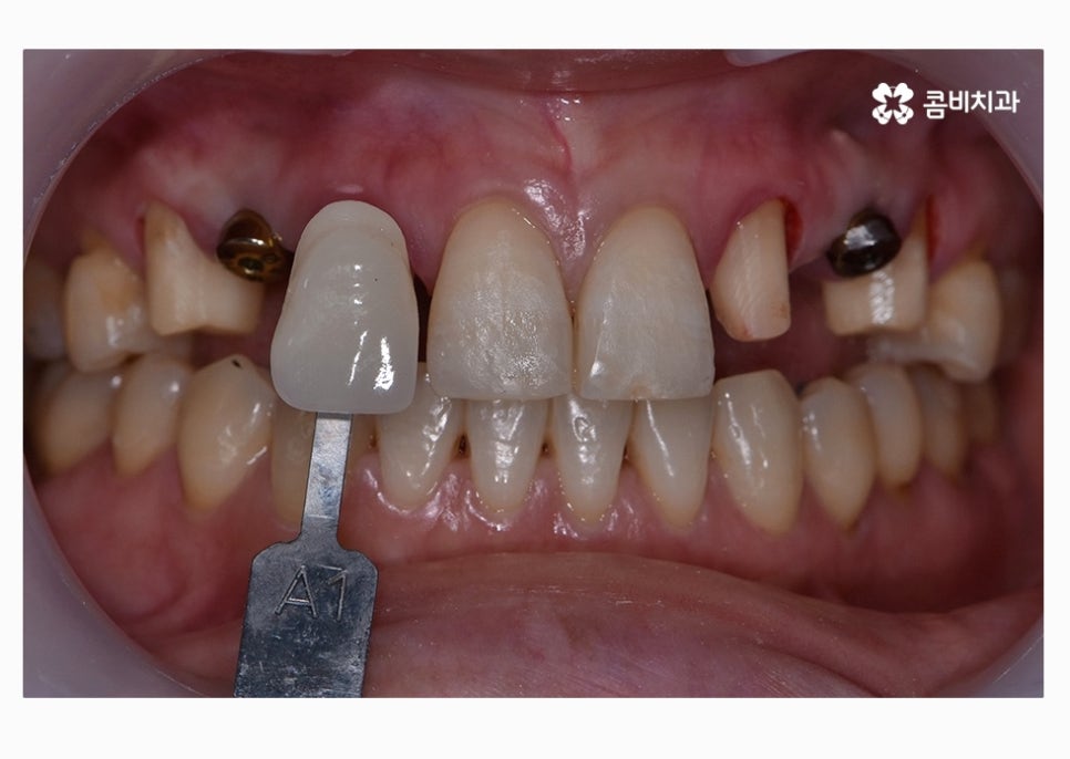 30대임플란트 향후 미래를 바라본다면 관련 이미지 11