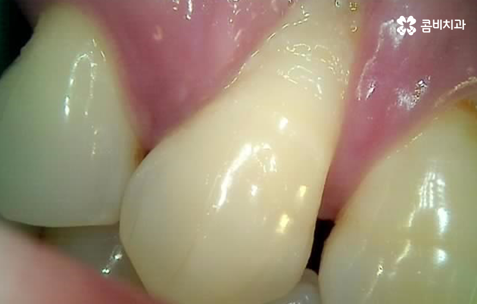치아 옆면 충치 이렇게 무섭습니다 관련 이미지 7