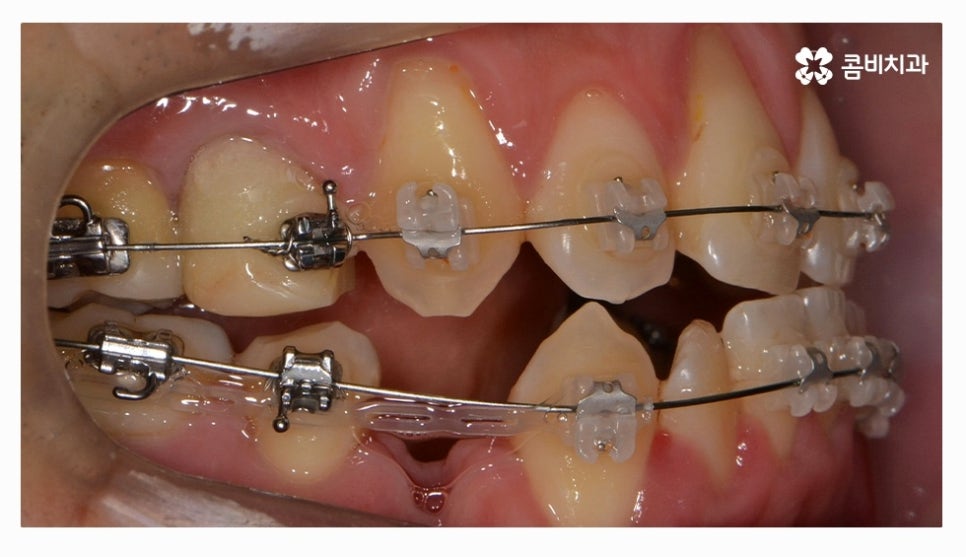 클리피씨교정 올바르게 판단하려면 관련 이미지 8