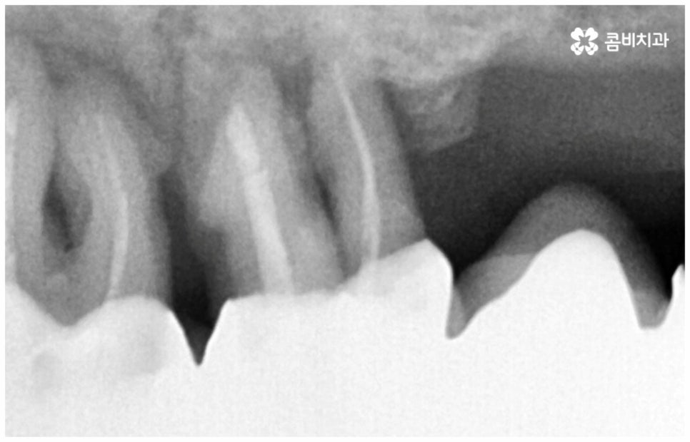 임플란트수명 연장하려면? 관련 이미지 5