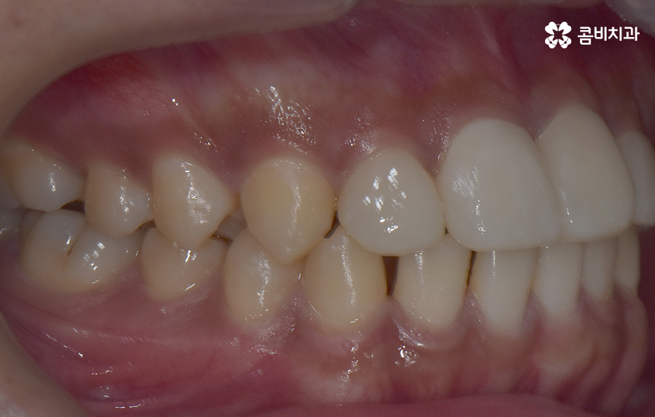 앞니만 교정 과잉치 뽑아서 해결했어요 관련 이미지 12