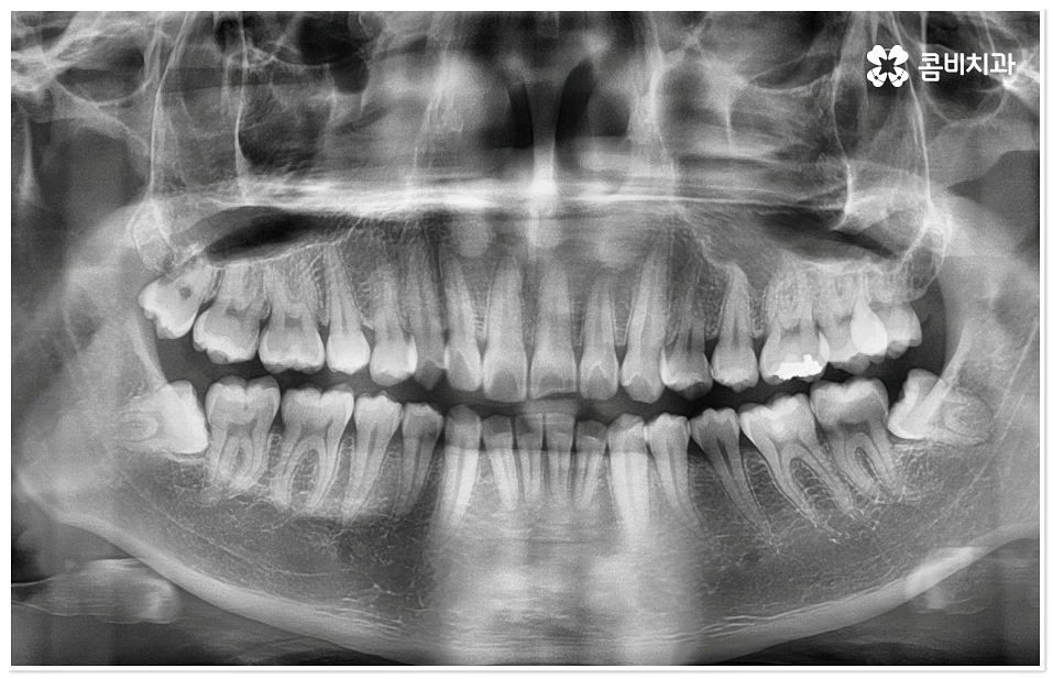 덧니치아교정 고려할 사항들은 관련 이미지 9