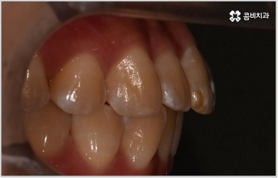 비발치치아교정 언제 할수있나요 관련 이미지 4