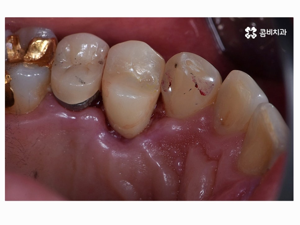 명동치과 누구나 놓치기 쉬운 문제점은! 관련 이미지 11