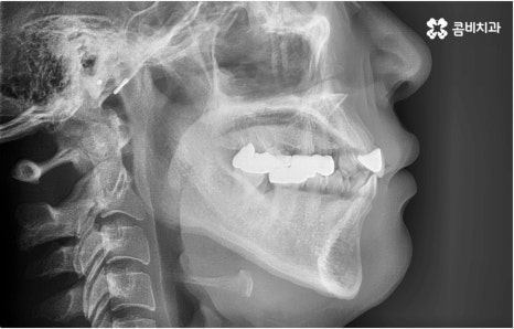 명동치과 타고난 이의 수명은 관련 이미지 2