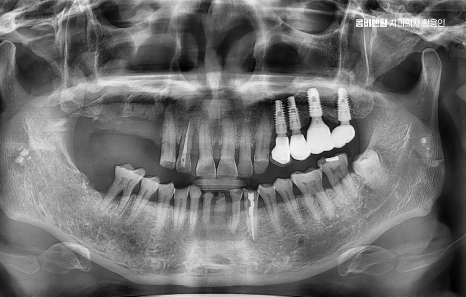 어금니 임플란트 과정 제대로 이해하려면 관련 이미지 2