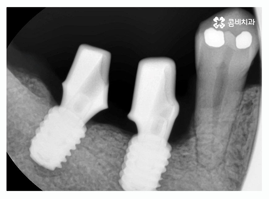 임플란트종류 잘알아보고 적용하려면 관련 이미지 7