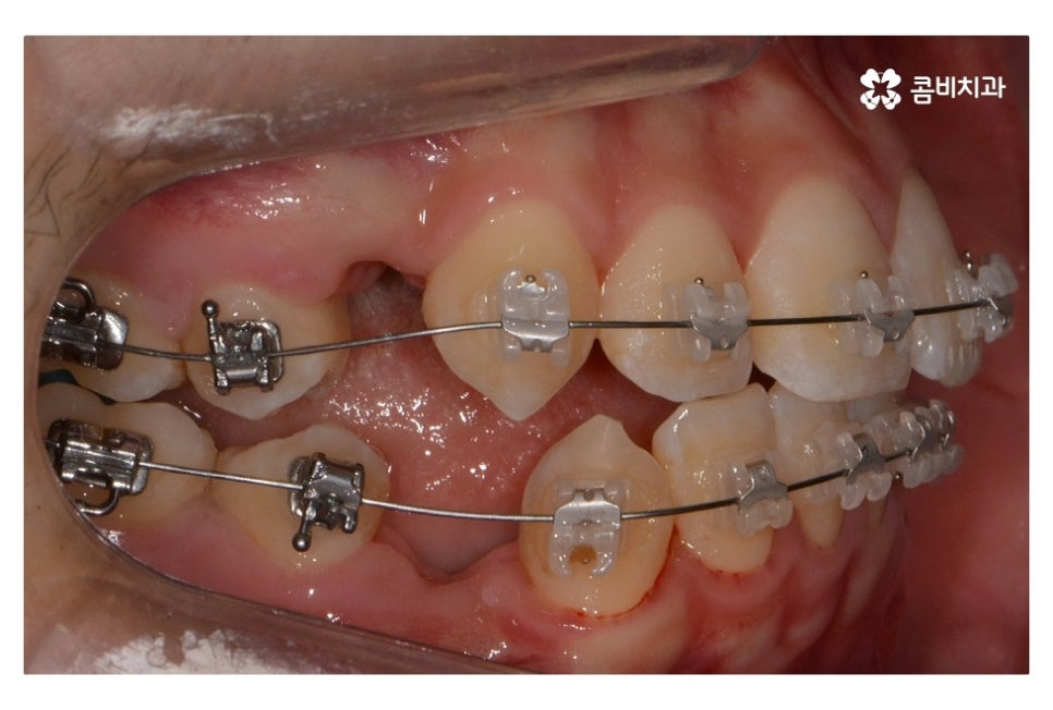 중학생치아교정 세심하게 체크하려면 관련 이미지 6
