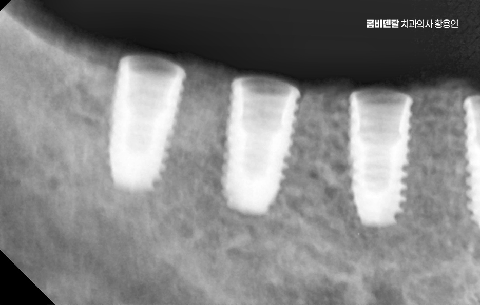 임플란트 뼈이식 안하면 어떤 문제가 있는거죠 관련 이미지 4