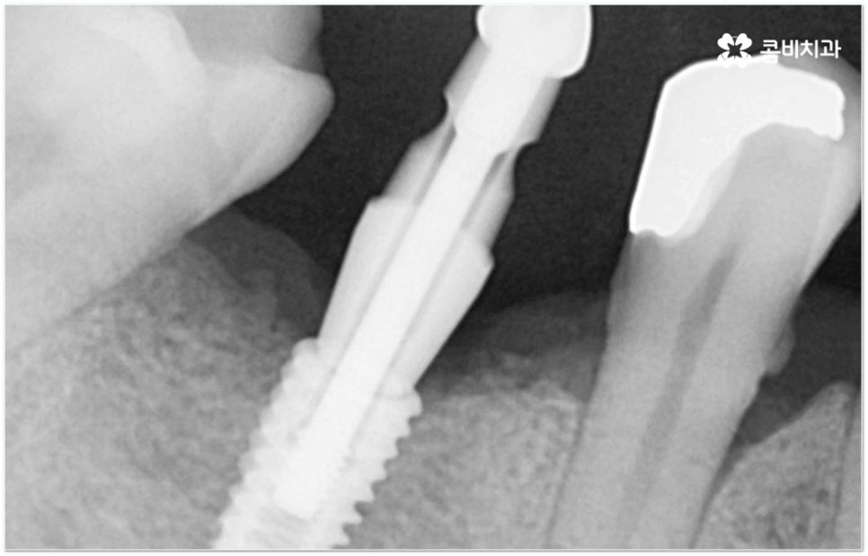 뼈이식임플란트 언제하나요? 관련 이미지 10