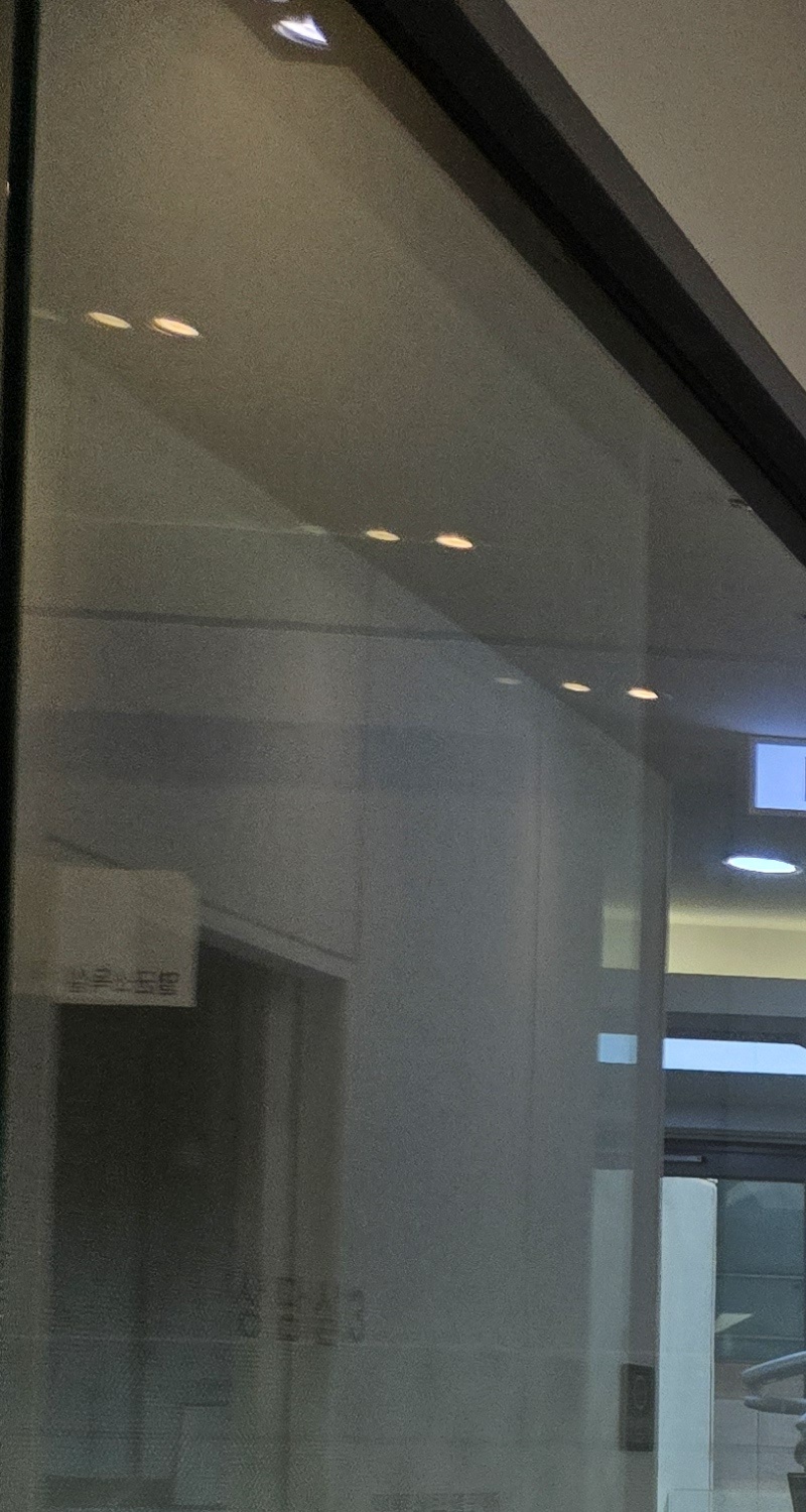 과개교합 교정 후 얼굴형 얼마나 바뀌나요 관련 이미지 12