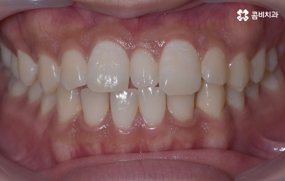 앞니만 교정 과잉치 뽑아서 해결했어요 관련 이미지 1