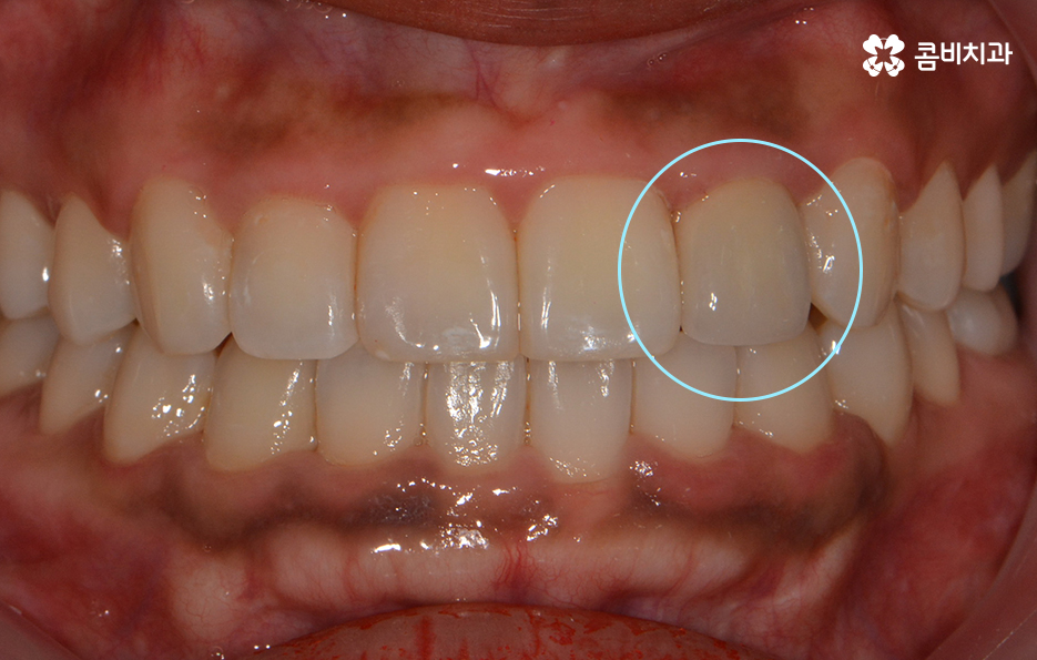 앞니 충치치료 개인에 따라 달라지는 이유 관련 이미지 4