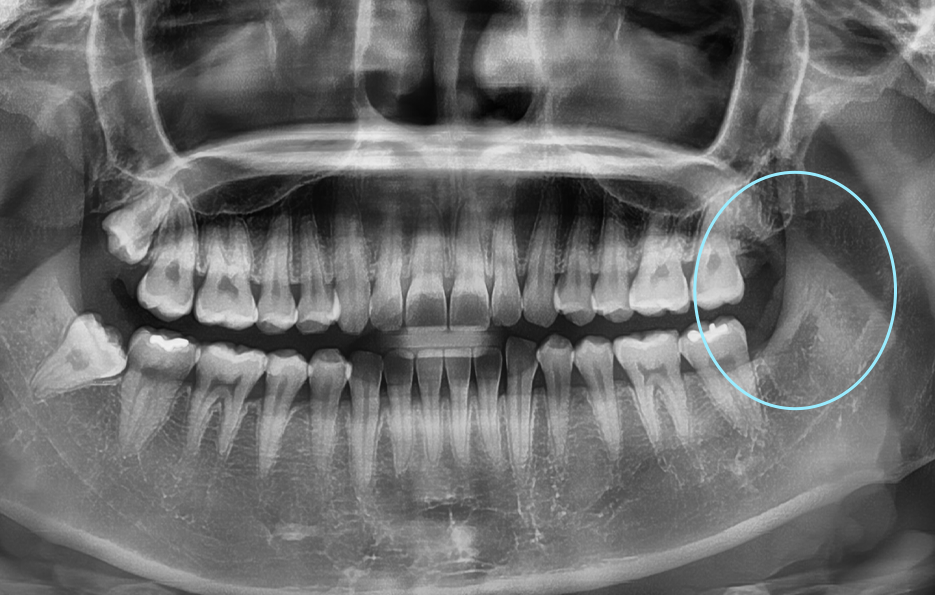 사랑니발치통증 이렇게 해야 쉬워져요 관련 이미지 7