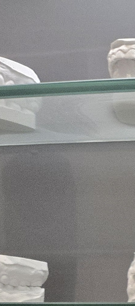 앞이빨 임플란트 과정 주의해야할 포인트는 관련 이미지 10