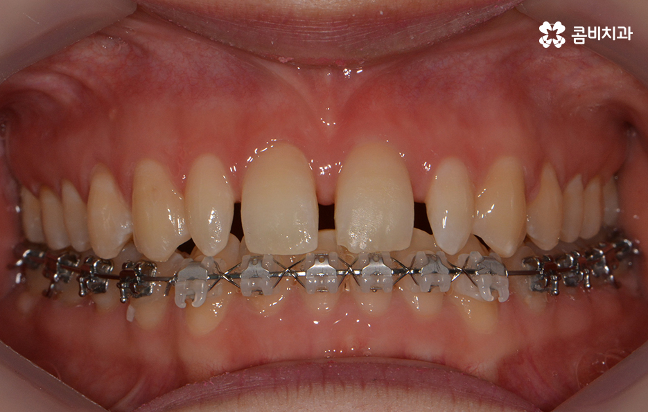 앞니 깨짐 치료와 교정이 병행되었던 사례 관련 이미지 8