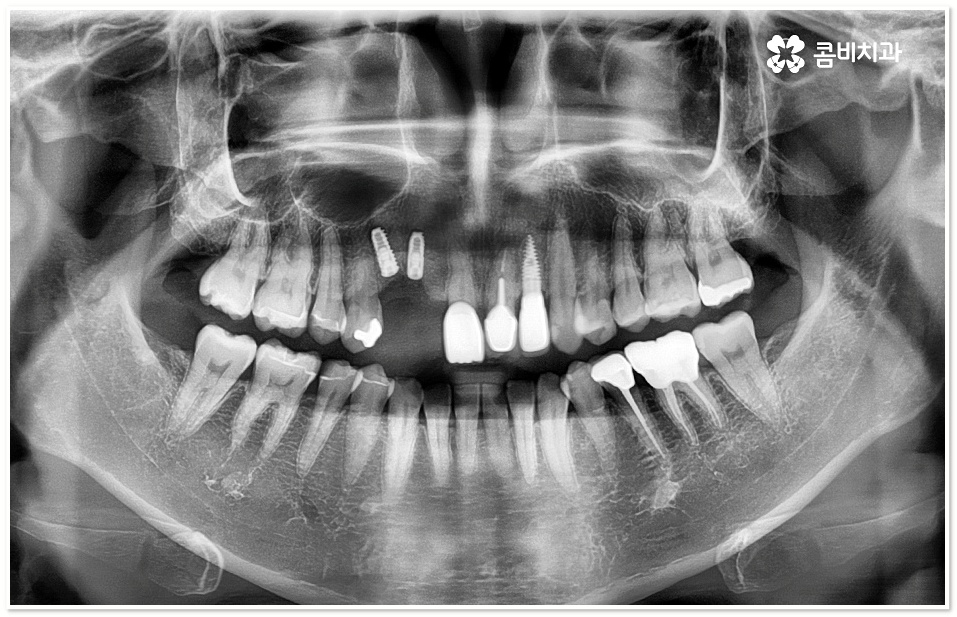 앞니임플란트 체크할 사항들은? 관련 이미지 2