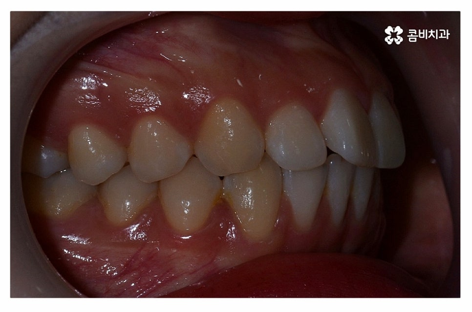 돌출입치아교정 적극적으로 해결하려면 관련 이미지 4