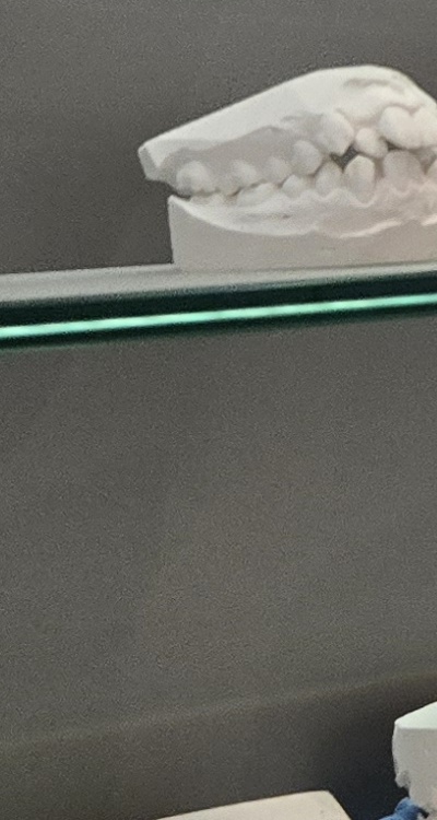 완전매복사랑니 발치 대학병원 꼭 가야하나요 관련 이미지 32