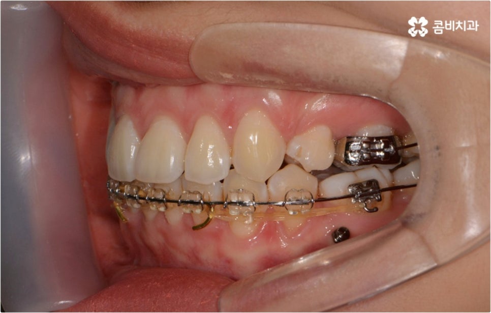 돌출입 치아교정 부모와 아이가 함께 알아봐요 관련 이미지 10