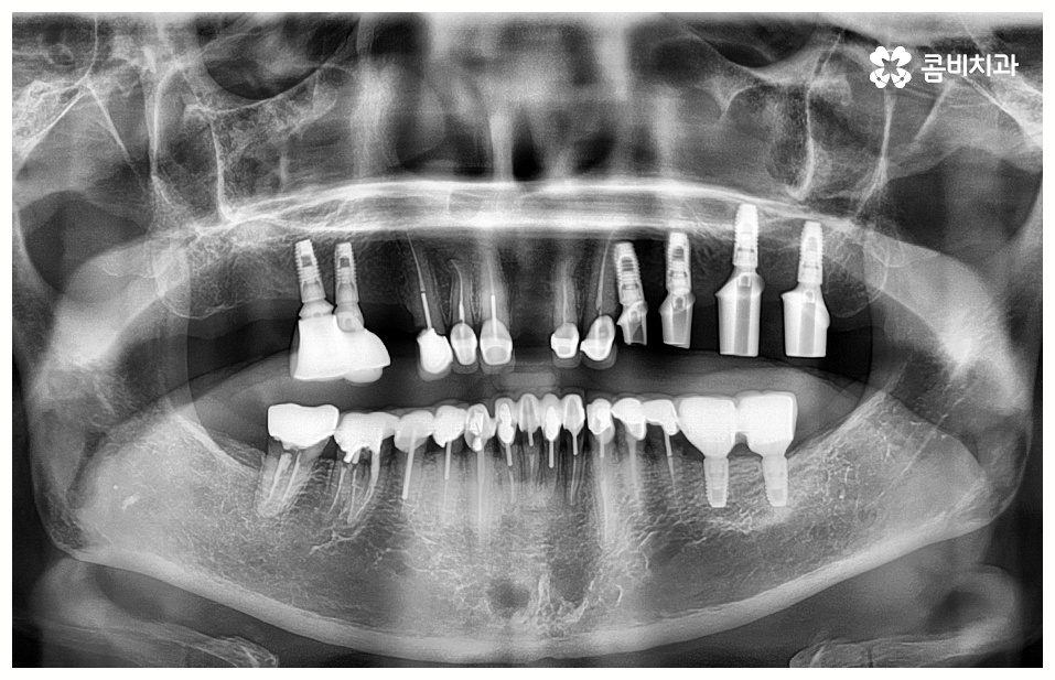 임플란트 치료기간 중점을 두어야 할것은 관련 이미지 4