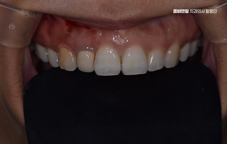 앞니 올세라믹 이건 알고 시작하세요 관련 이미지 2