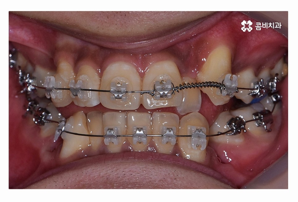 덧니 발치 필수적으로 하는건가요 관련 이미지 7