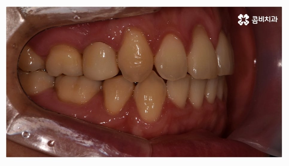 클리피씨교정 올바르게 판단하려면 관련 이미지 14
