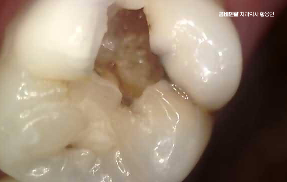 신경치료 아픈가요 망설이시는 분들이라면 관련 이미지 5