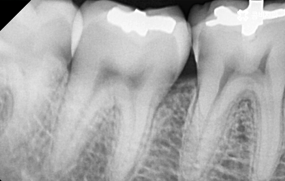 어금니 충치 발치 결국 뽑아야 할때와 살릴 수 있는 케이스 관련 이미지 7