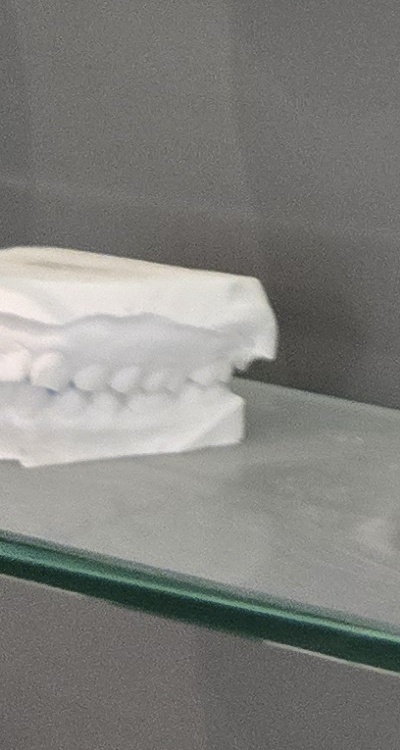 윗니 전체 임플란트 뭐부터 해야할까 관련 이미지 32