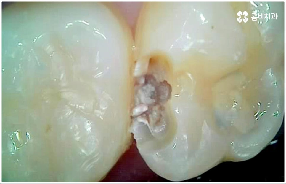 치아사이충치 놔두면 안돼요 관련 이미지 2