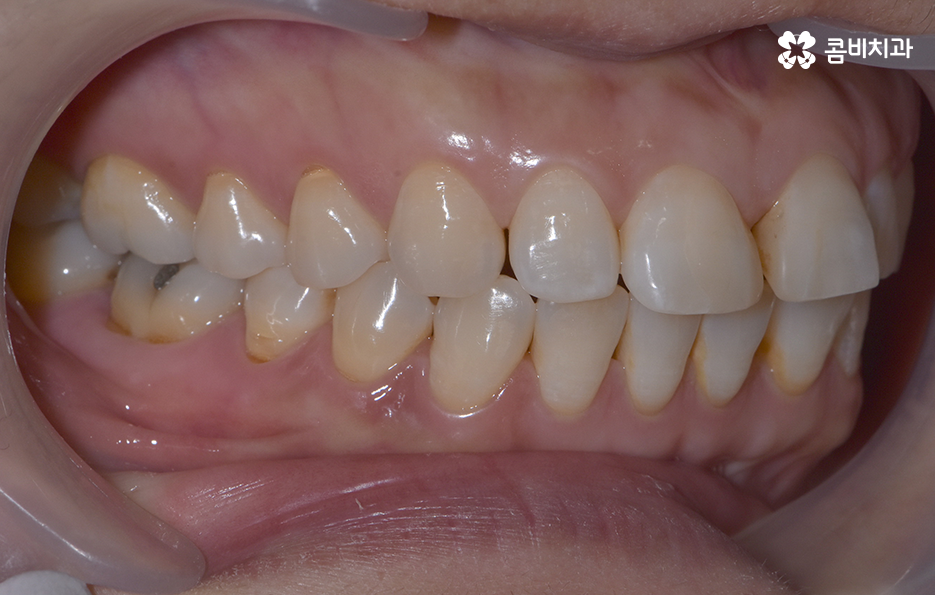 중년치아교정 이제라도 해도 될까요 관련 이미지 2