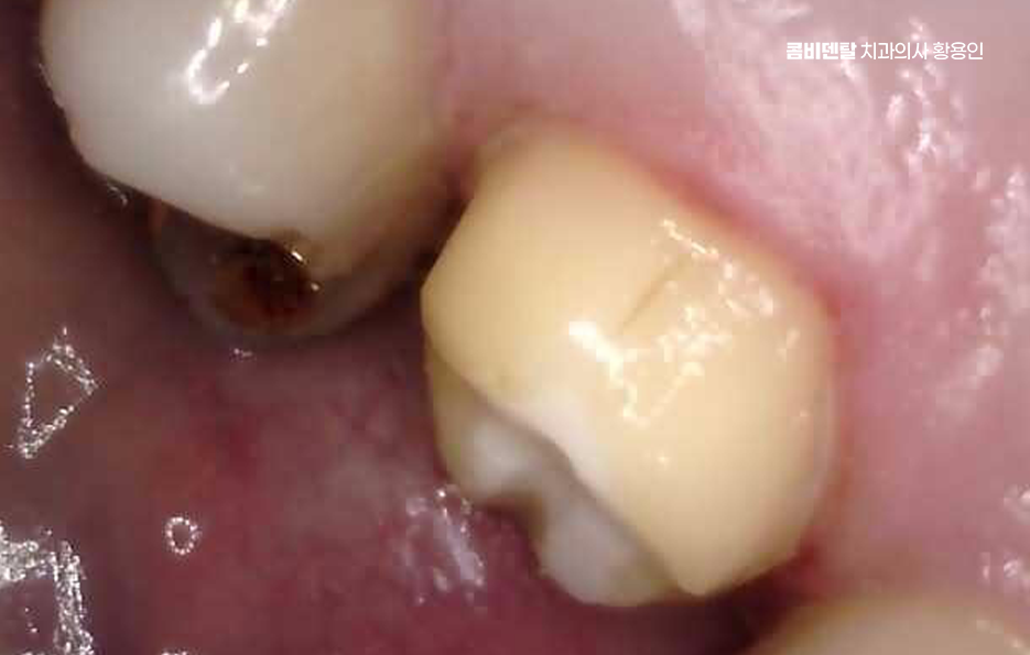 인레이 치료 후 통증 자꾸 심해지는데 괜찮은걸까 관련 이미지 9