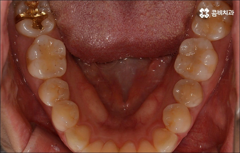 앞니 돌출 어떻게 고치나요? 관련 이미지 8