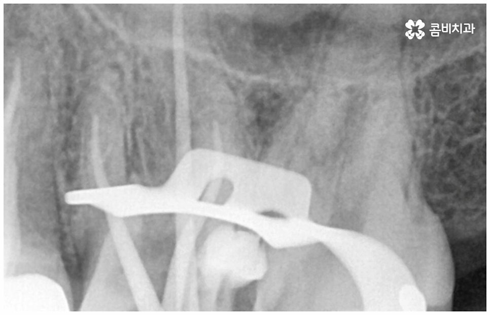 어금니신경치료 케이스마다 달라요 관련 이미지 5