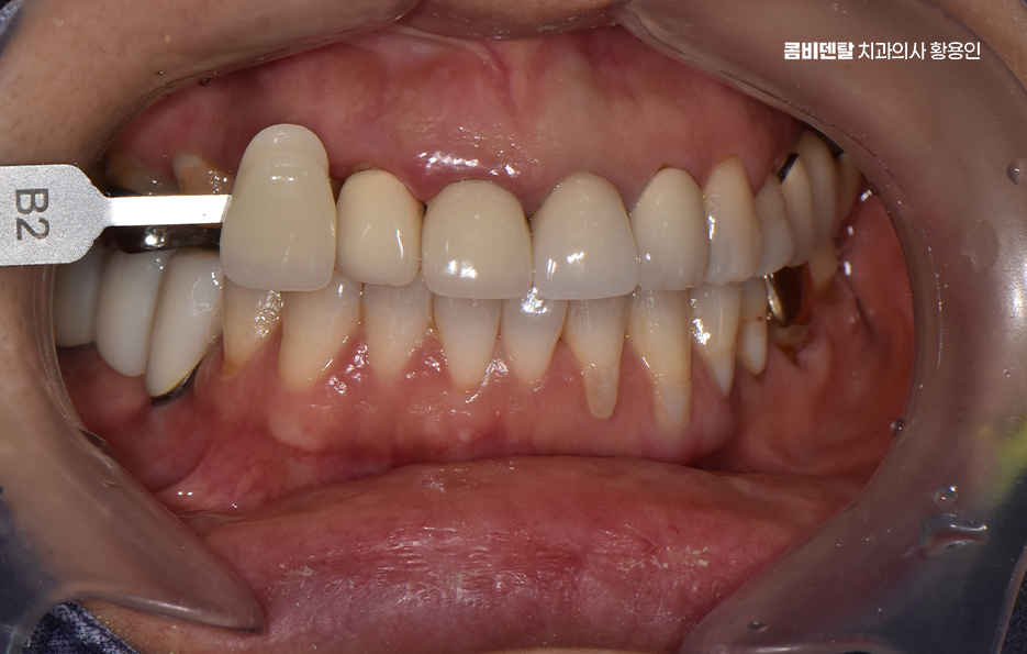 앞니 크라운 교체 깔끔하게 정리하려면 관련 이미지 4
