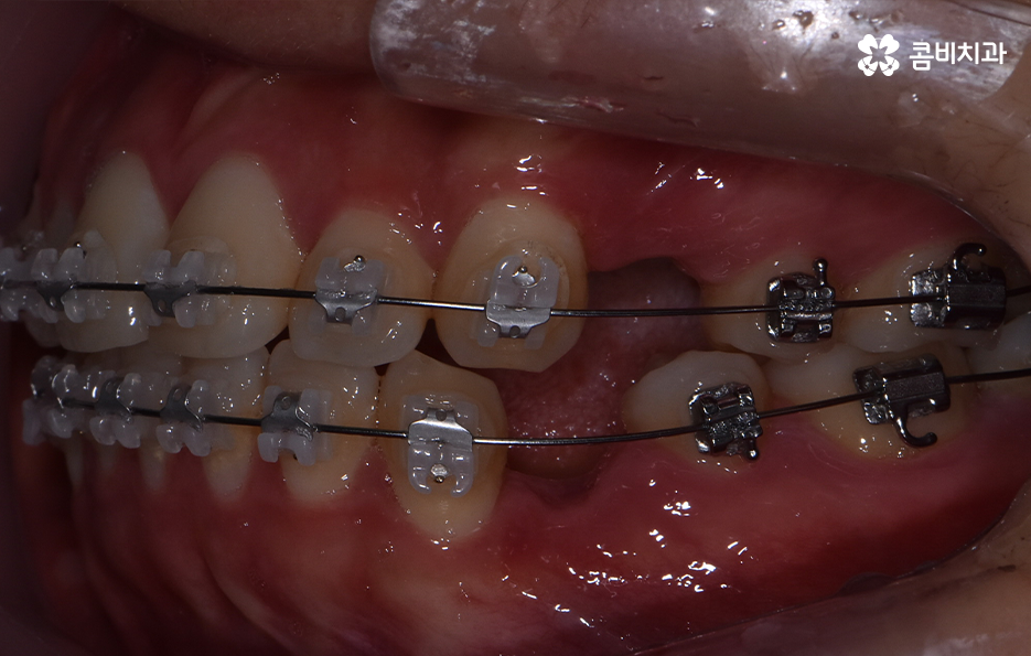 돌출입발치교정 기대해봐도 될까요 관련 이미지 8