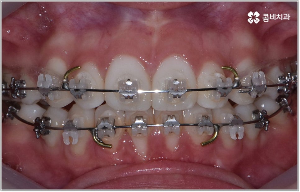 돌출입치아교정 언제가 적기인가요? 관련 이미지 6
