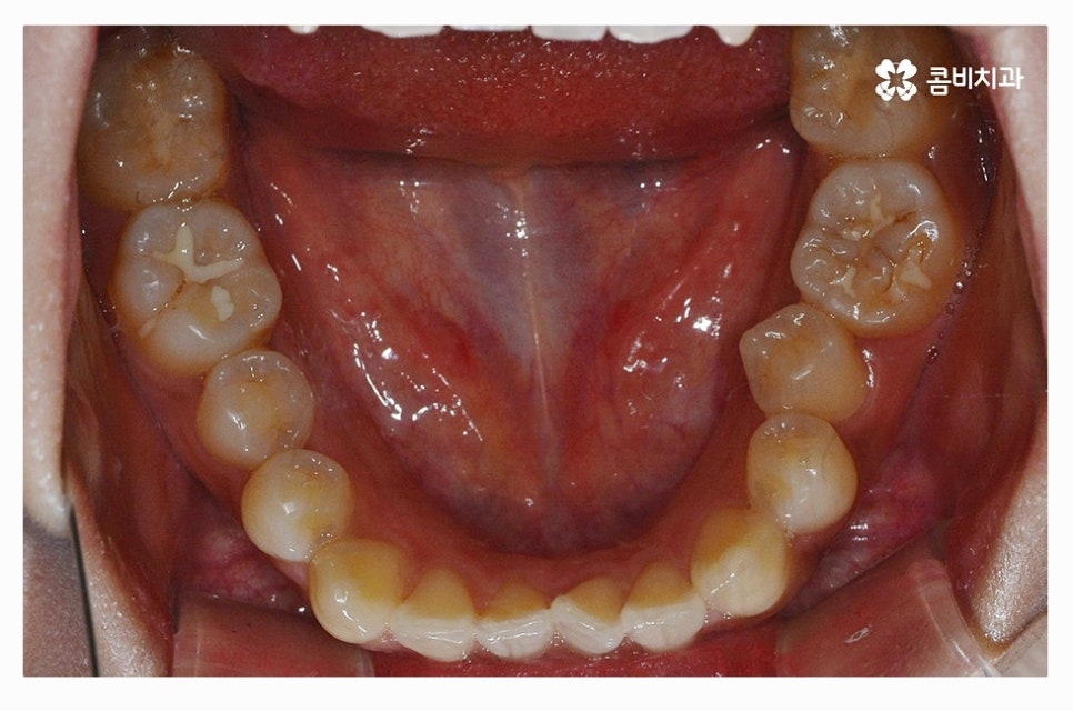 덧니교정 정교하게 따져보려면 관련 이미지 5