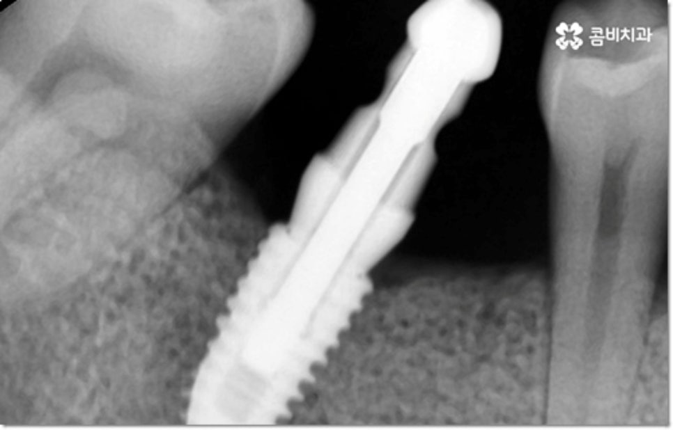 아랫니임플란트 주의할것들은? 관련 이미지 4