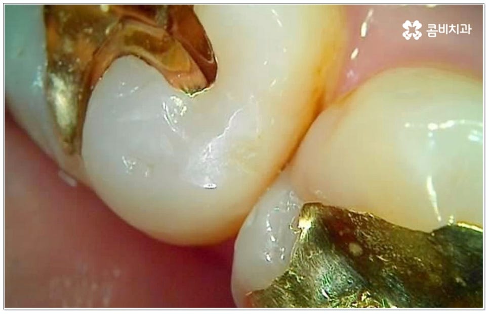 충치 인레이 언제 받나요? 관련 이미지 5
