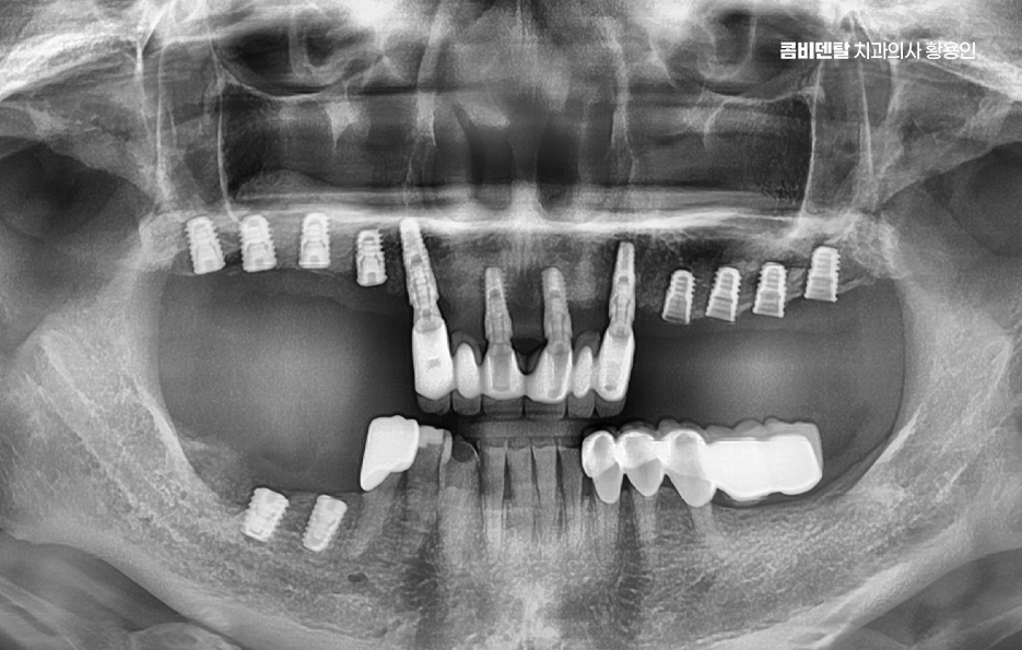 어금니 임플란트 뼈이식 이럴때 해당됩니다 관련 이미지 7