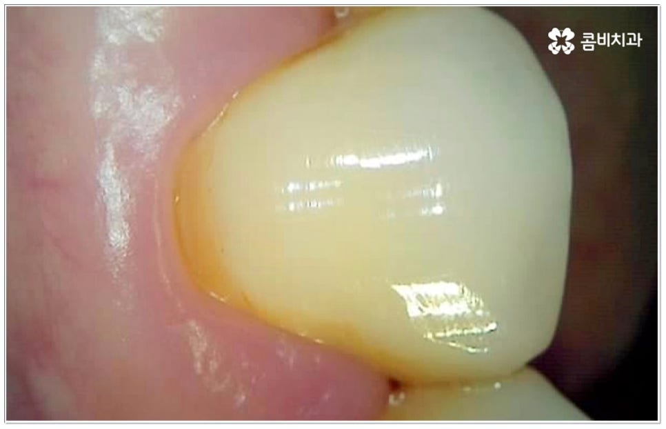 충치 인레이 언제 받나요? 관련 이미지 3