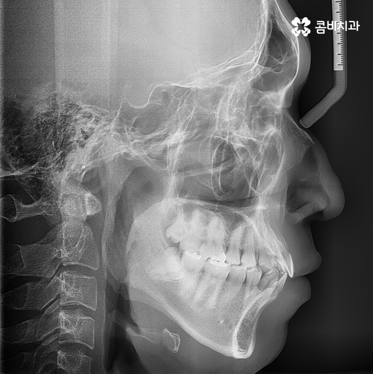 치아부분교정 내게도 적합한지 알아보려면 관련 이미지 1