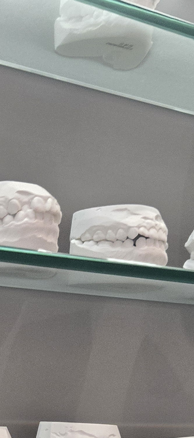 앞니 틀어짐 교정 이렇게 파악하세요 관련 이미지 13